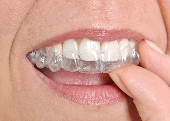 Invisalign