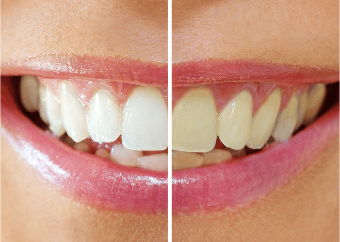 Teeth Whitening